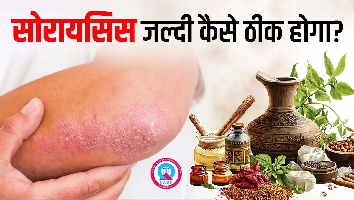 सोरायसिस जल्दी कैसे ठीक होगा?